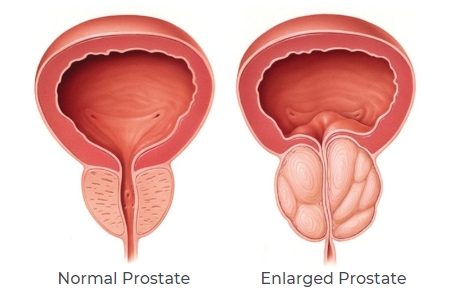 prostata ingrossata