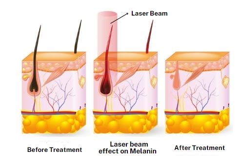 funzionameto epilazione laser diodo