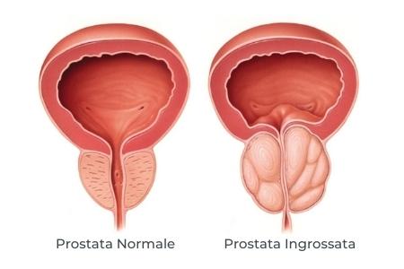 prostata ingrossata