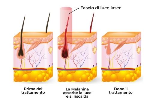 funzionameto epilazione laser diodo